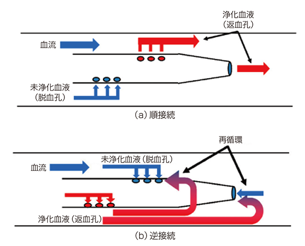 図4 DLCの順接続と逆接続及び再循環