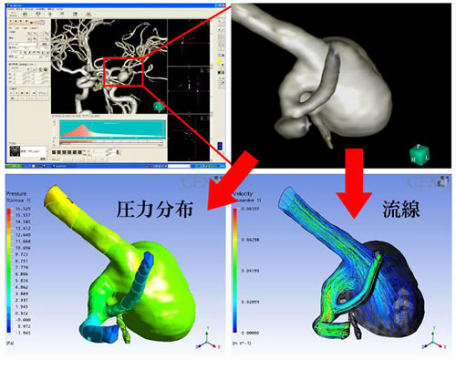 脳動脈瘤内の血流動態 解析事例