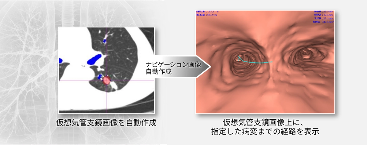 病変にアプローチする経路を自動生成するDirectPath