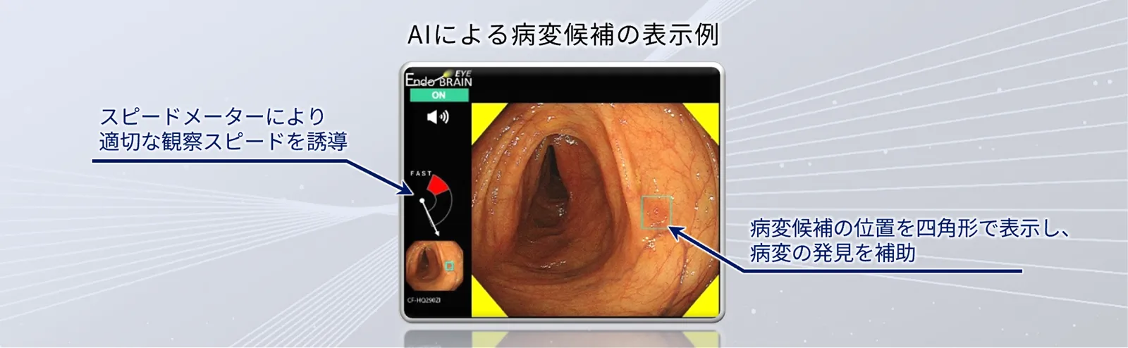 内視鏡画像診断支援プログラムEndoBRAIN-EYEを利用した、AIによる病変候補の表示例