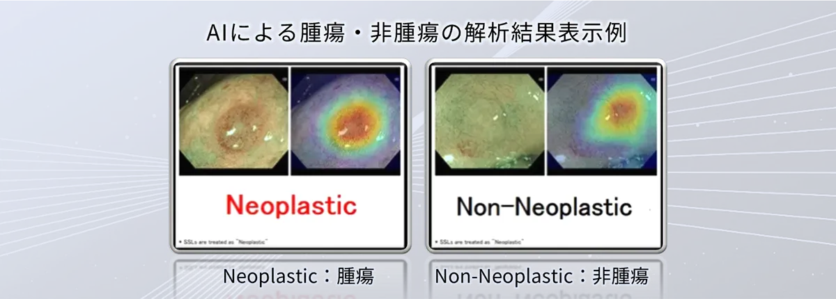 EndoBRAIN-Xを利用した、AIによる腫瘍・非腫瘍の解析結果表示例​