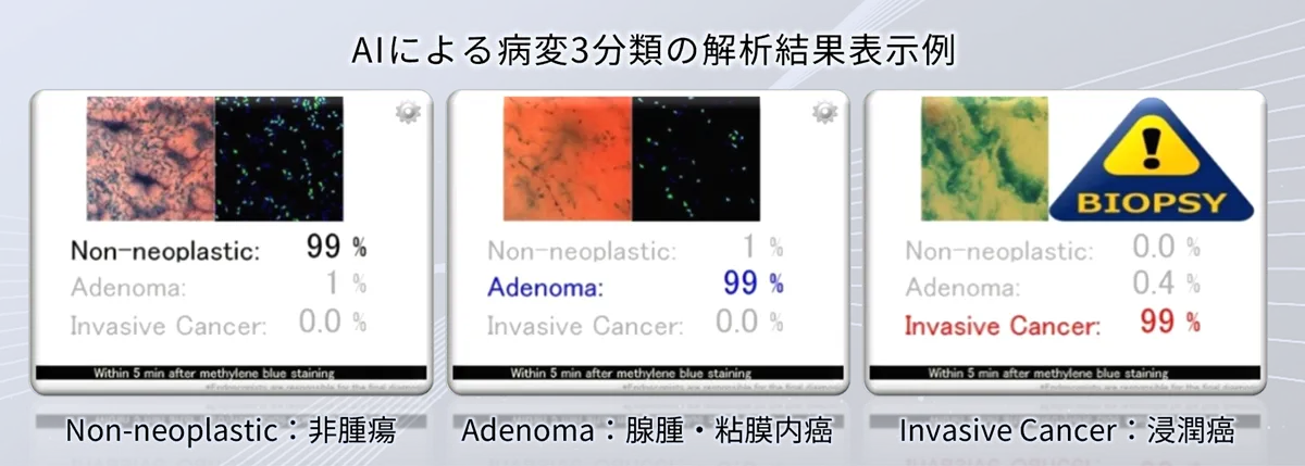 EndoBRAIN-Plusを利用した、AIによる病変3分類の解析結果表示例​