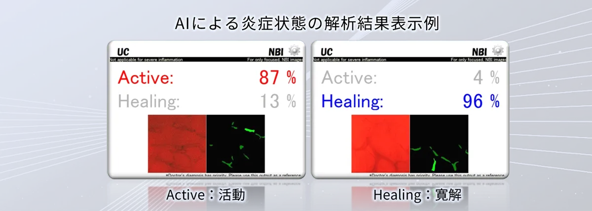 EndoBRAIN-UCを利用した、AIによる炎症状態の解析結果表示例​