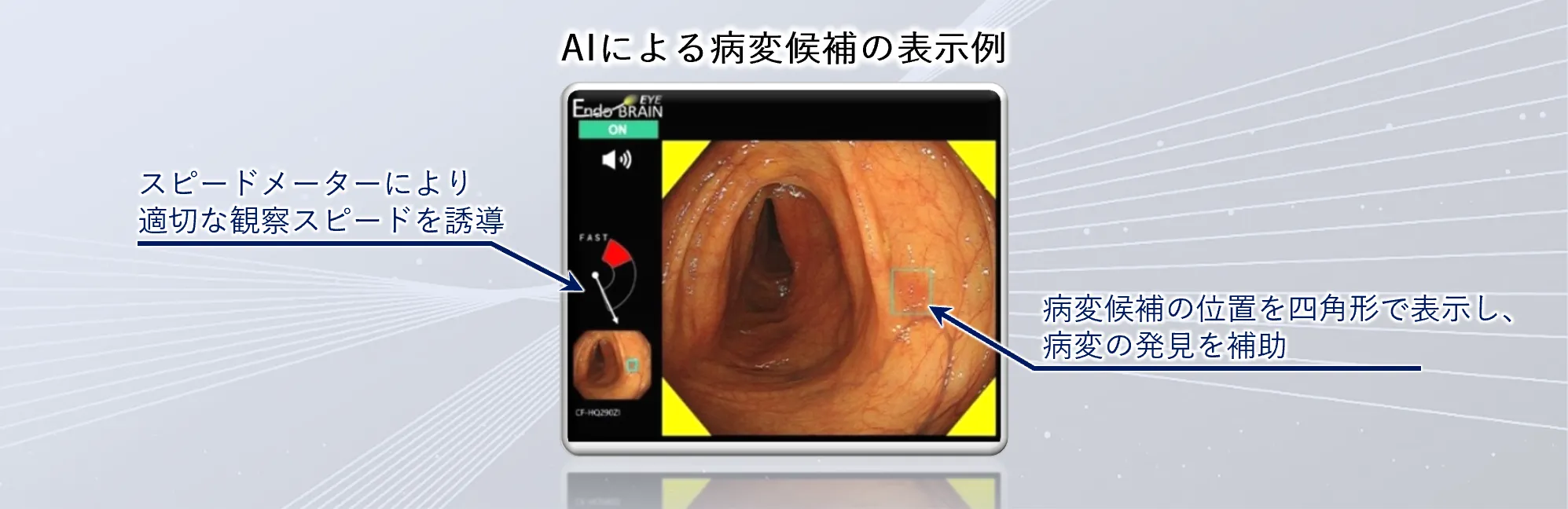 内視鏡画像診断支援プログラムEndoBRAIN-EYE