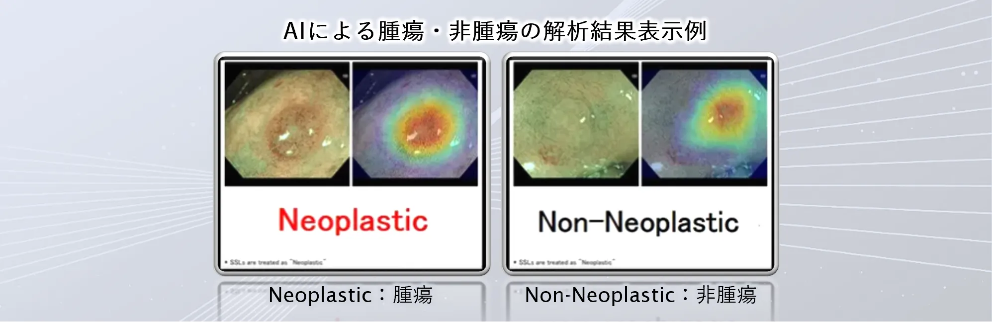 内視鏡診画像断支援ソフトウェアEndoBRAIN-X